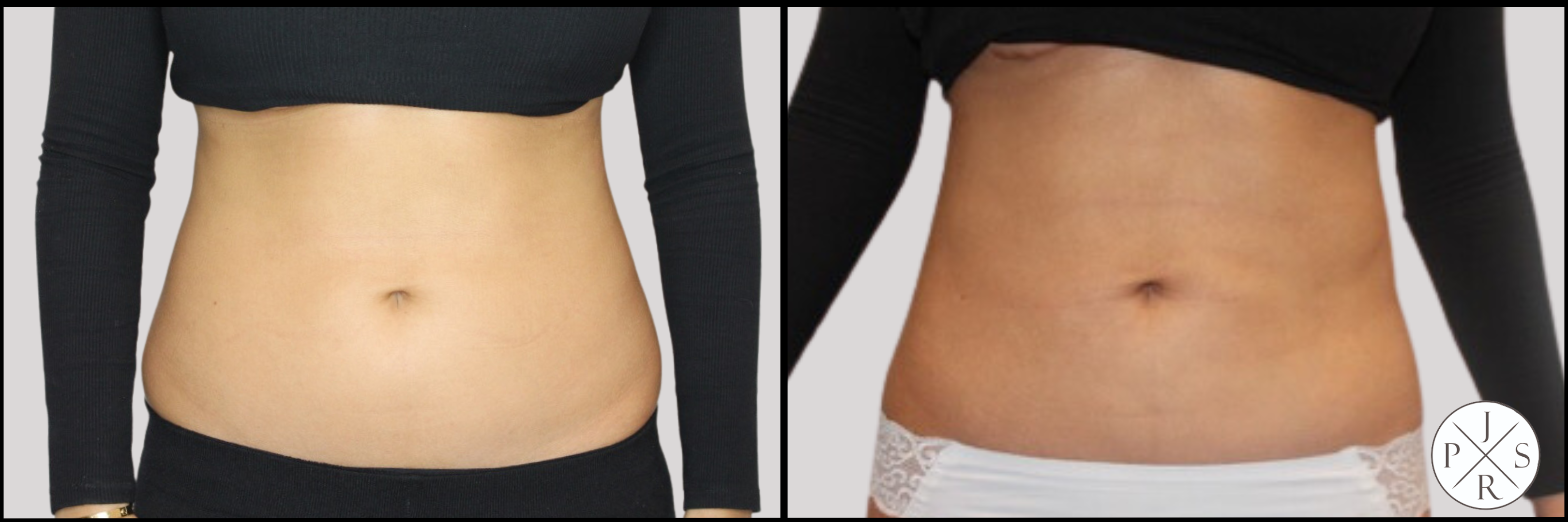 Liposuction Before & After Image